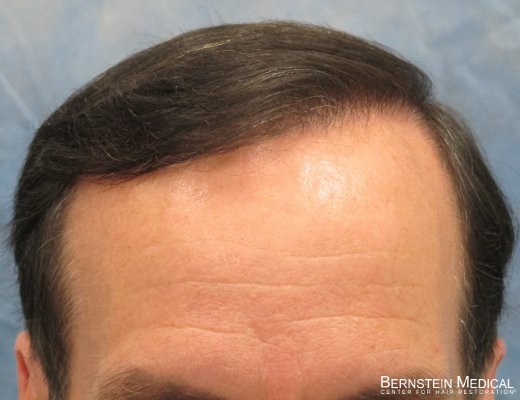 After 2nd Session - Detail of Hairline

View his full photoset >> http://www.bernsteinmedical.com/hair-transplant-photos/portraits/patient-apl/
