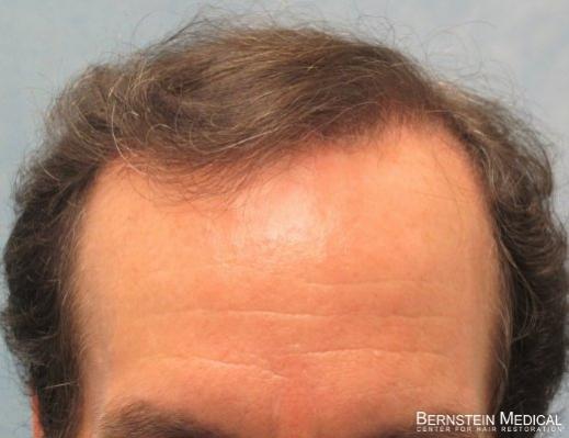 After 1st Session  - Detail of Hairline

View his full photoset >> http://www.bernsteinmedical.com/hair-transplant-photos/portraits/patient-apl/
