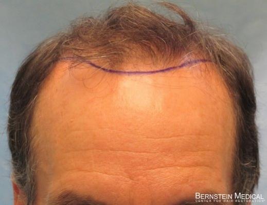 Position of Planned Hairline - Detail of Hairline

View his full photoset >> http://www.bernsteinmedical.com/hair-transplant-photos/portraits/patient-apl/