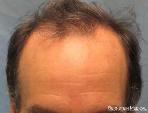Patient APL Before Hair Transplant - Detail of Hairline

View his full photoset >> http://www.bernsteinmedical.com/hair-transplant-photos/portraits/patient-apl/