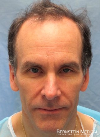 Patient APL Before Transplant

View his full photoset >> http://www.bernsteinmedical.com/hair-transplant-photos/portraits/patient-apl/