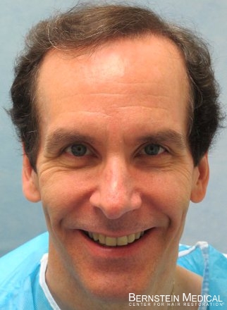 After 2,908 grafts at one year post-op

View his full photoset >> http://www.bernsteinmedical.com/hair-transplant-photos/portraits/patient-apl/