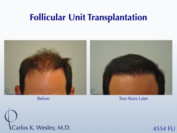 A 42-year-old man had two (2) prior hair transplants with poor results.  He came to Dr. Carlos K. Wesley (NYC) for a repair to create a more natural and full-appearing hairline.  

A full video montage of his transformation can be viewed at: https://vimeo.com/53079878