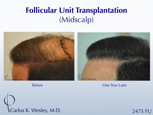 A 42-year-old man had two (2) prior hair transplants with poor results.  He came to Dr. Carlos K. Wesley (NYC) for a repair to create a more natural and full-appearing hairline.  

A full video montage of his transformation can be viewed at: https://vimeo.com/53079878