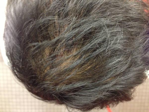 Bald Truth Talk - Hair Loss, Hair Transplant and Hair Restoration Community