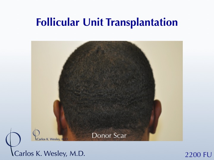 A 35-year-old African-American male underwent a 2200 FU session with Dr. Carlos K. Wesley (NYC).  His donor area afterwards.