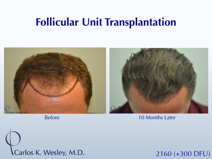A 40-year-old male underwent a 2460 FU session of FUT with Dr. Carlos K. Wesley (NYC).