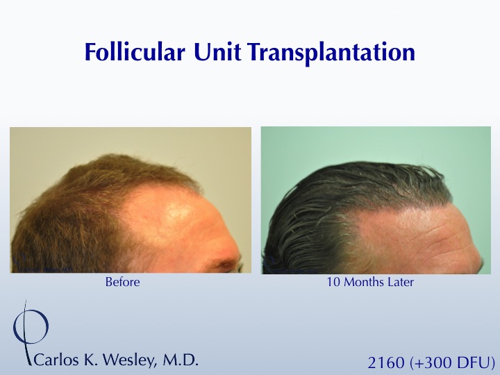 A 40-year-old male underwent a 2460 FU session of FUT with Dr. Carlos K. Wesley (NYC).