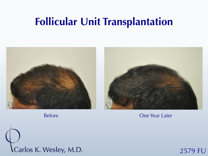 A 34-year-old male had 2579 FU added to his mid scalp to minimize his balding crown.