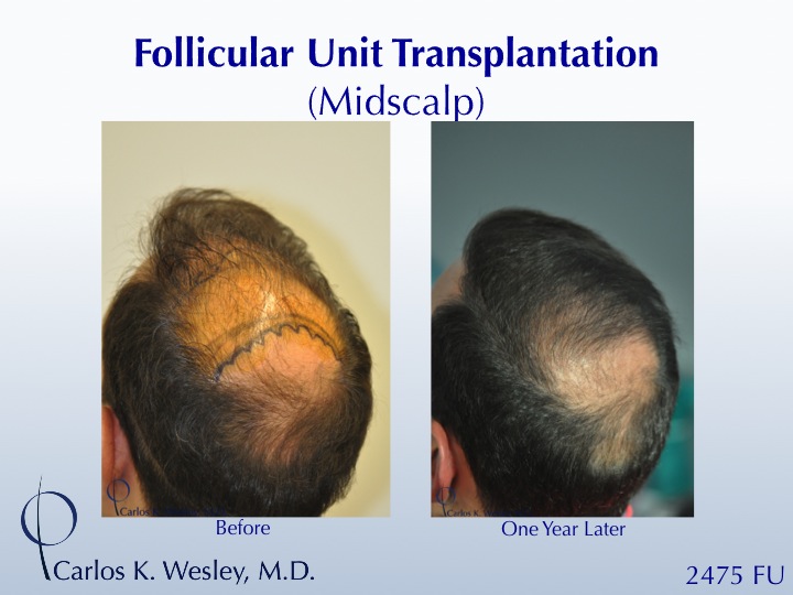This 42-year-old man had two bad transplants at another office prior to coming to Dr. Wesley (NYC) for a revision of his hairline and subsequent mid scalp treatment.
