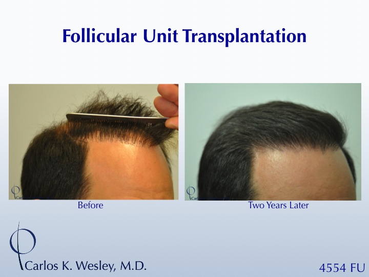 This 42-year-old man had two bad transplants at another office prior to coming to Dr. Wesley (NYC) for a revision of his hairline and subsequent mid scalp treatment.