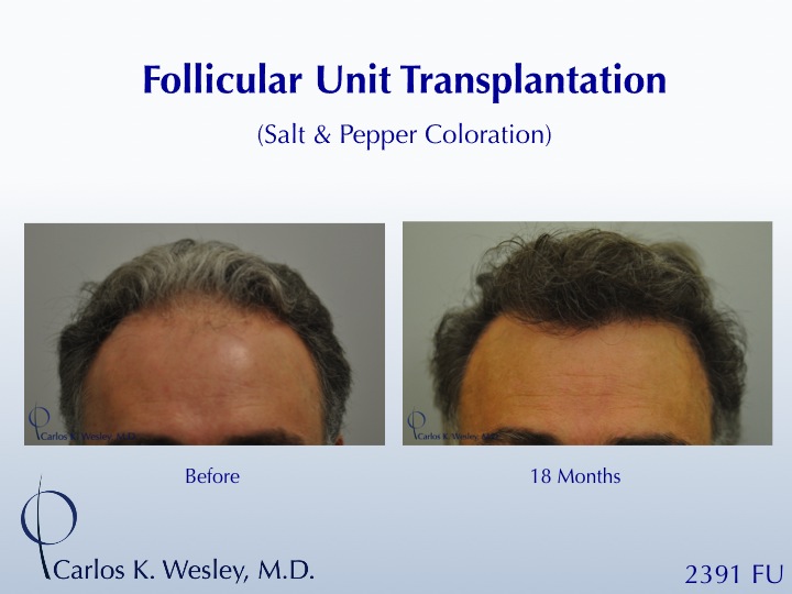 46-year-old male with curly hair of salt & pepper coloration46-year-old male with curly hair of salt & pepper coloration underwent two sessions totaling 4637 FU with Dr. Carlos K. Wesley (NYC).