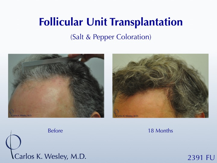 46-year-old male with curly hair of salt & pepper coloration underwent two sessions totaling 4637 FU with Dr. Carlos K. Wesley (NYC).