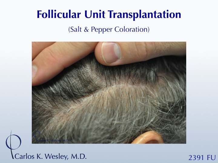 46-year-old male with curly hair of salt & pepper coloration underwent two sessions totaling 4637 FU with Dr. Carlos K. Wesley (NYC).  His resultant fine donor scar.