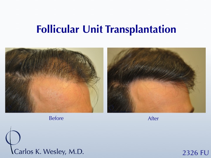 This 42-year-old man simply wanted a thicker hairline.  A 2326 FU session with Dr. Carlos K. Wesley (NYC) helped him accomplish his objective.