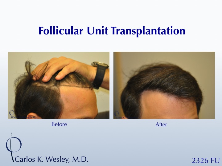 This 42-year-old man simply wanted a thicker hairline.  A 2326 FU session with Dr. Carlos K. Wesley (NYC) helped him accomplish his objective.