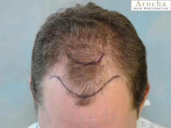 Twenty-nine year gentleman wanted to have a natural looking hair transplant to restore the framing of his face. Arocha Hair Restoration performed a 3,000 follicular unit procedure. The after results are two years post-procedure. He is now looking to perform a small second session to increase fullness and work into the frontal to mid-scalp area.
