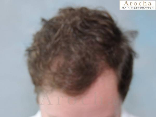 Twenty-nine year gentleman wanted to have a natural looking hair transplant to restore the framing of his face. Arocha Hair Restoration performed a 3,000 follicular unit procedure. The after results are two years post-procedure. He is now looking to perform a small second session to increase fullness and work into the frontal to mid-scalp area.