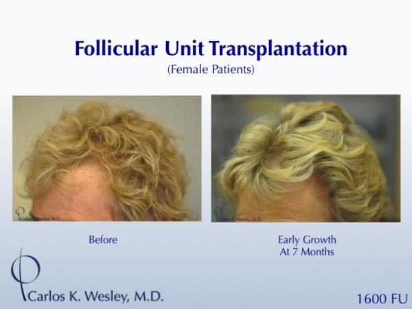 A female patient showing early growth after a 1600FU session with Dr. Wesley.  Her grafts were incubated in chilled PRP during her FUT procedure, which has demonstrated a trend toward slightly earlier growth.