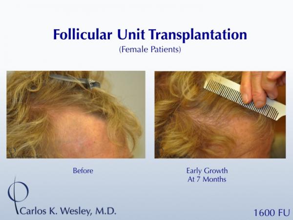 A female patient showing early growth after a 1600FU session with Dr. Wesley.  Her grafts were incubated in chilled PRP during her FUT procedure, which has demonstrated a trend toward slightly earlier growth.