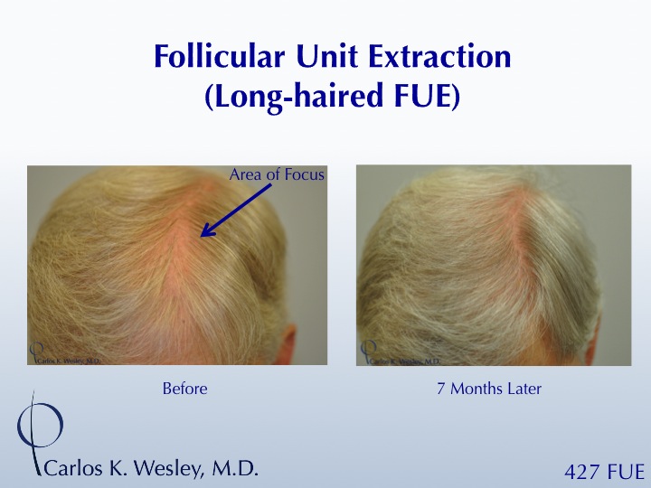 Focused, long-haired FUE