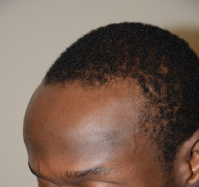 Before surgical hairline advancement/ forehead shortening procedure.