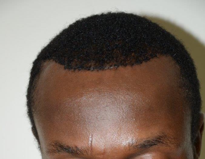 After surgical hairline advancement surgery/forehead shortening surgery.