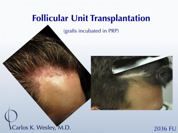 25-year-old male with 2034 FU session with Dr. Carlos K. Wesley for hairline fullness.