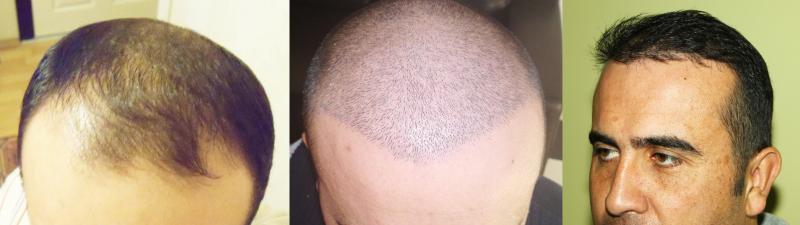 Dr. Hakan DOGANAY, 4300 Grafts, After 1 and 2 years, FUE