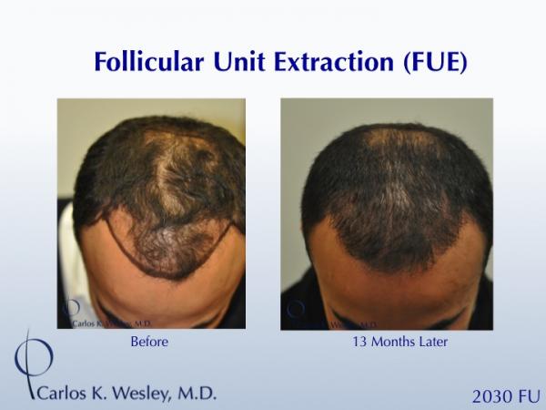 Before and 13 months after FUE with Carlos K. Wesley (NYC).