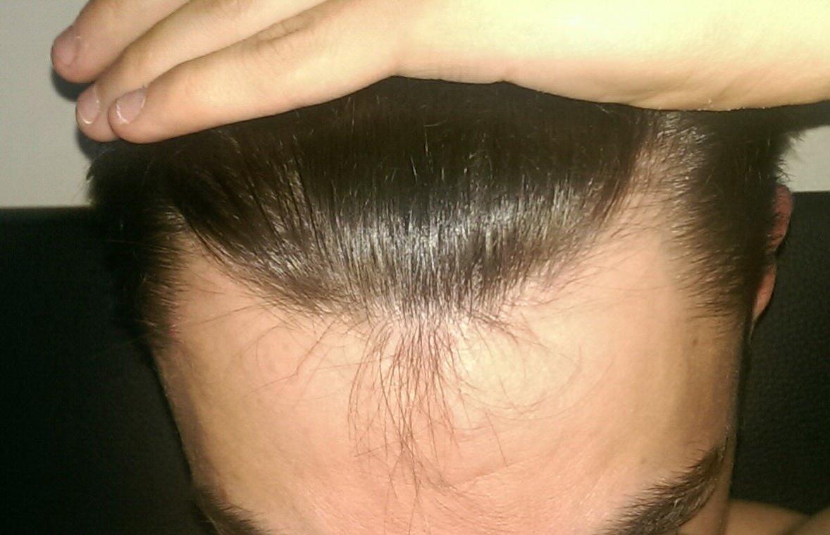Am I Balding Or Maturing Im Only 21 Nearly 22 Pictures