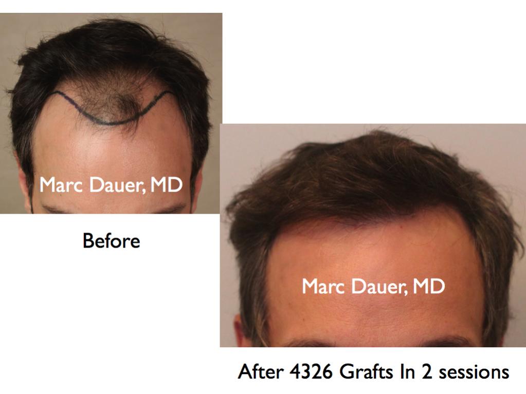 Click image for larger version

Name:	Hair Transplant Slides2.237.jpg

Size:	58.0 KB
ID:	34133
