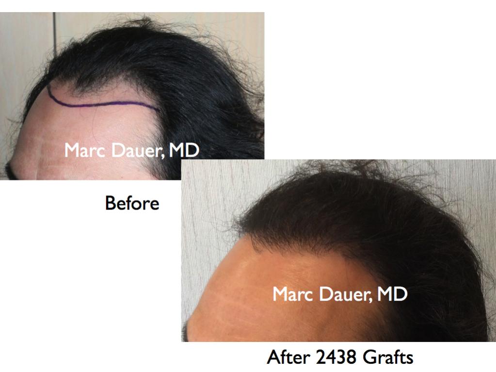 Click image for larger version

Name:	Hair Transplant Slides1.240.jpg

Size:	65.3 KB
ID:	34137