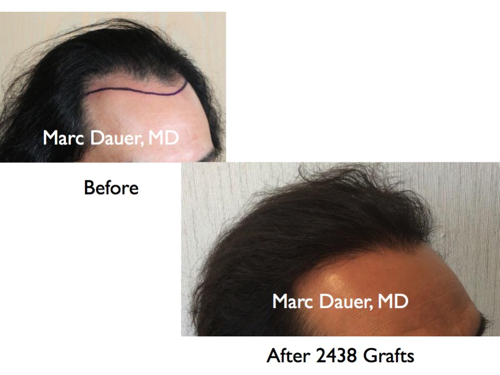 Click image for larger version

Name:	Hair Transplant Slides1.241.jpg

Size:	60.3 KB
ID:	34138