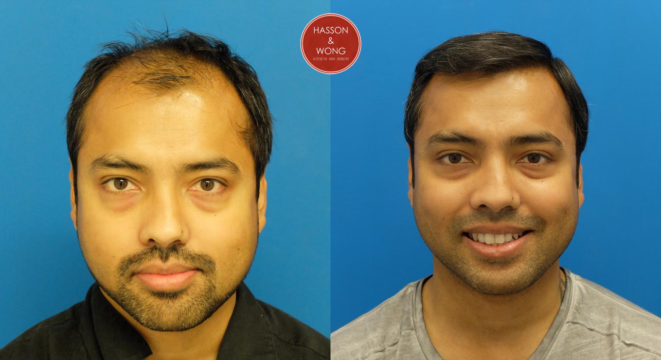 Dr.Hasson 5300 Grafts/ 1 Session/FUT/ 8 Months Post Op