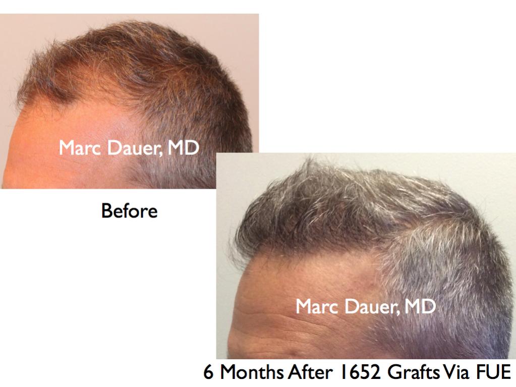 Click image for larger version

Name:	Hair Transplant Slides9.258.jpg

Size:	74.2 KB
ID:	34777