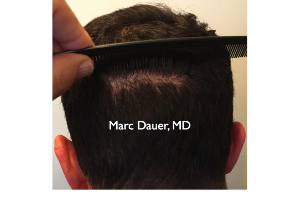 Click image for larger version

Name:	Hair Transplant Slides5.326.jpg

Size:	45.2 KB
ID:	35805
