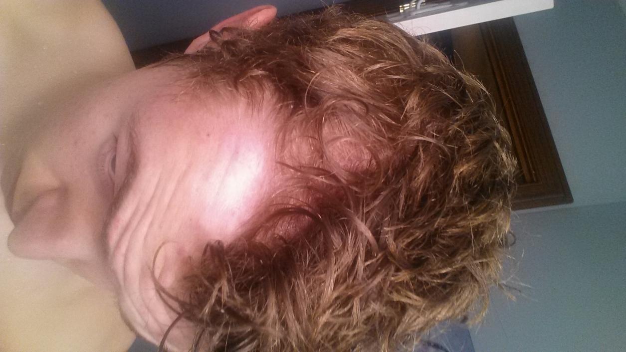 Thinning At 18 Years Old My Introduction Baldtruthtalk Com