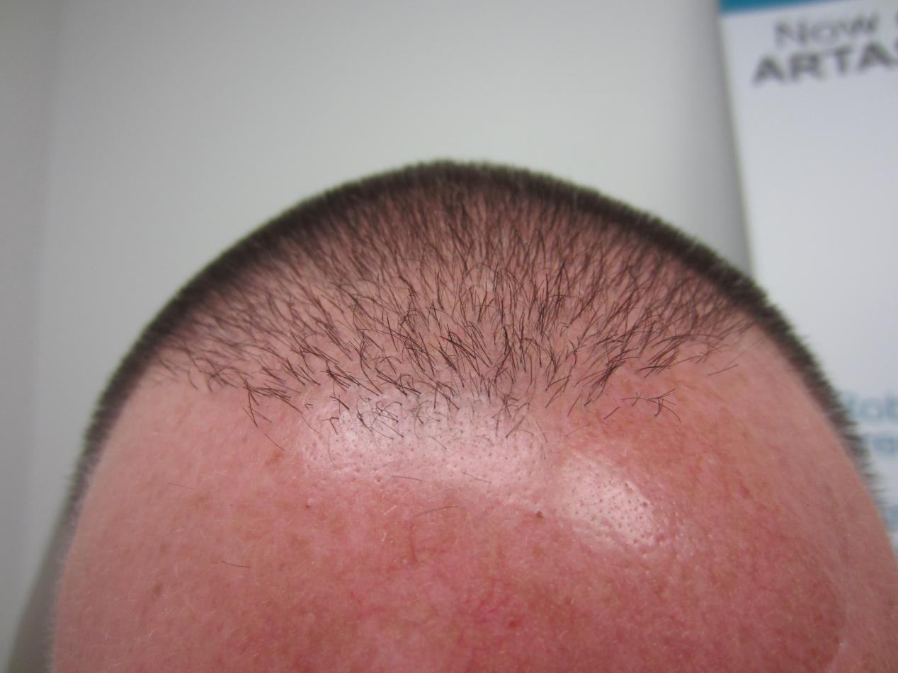 After 100 FUE Hair Graft Implants