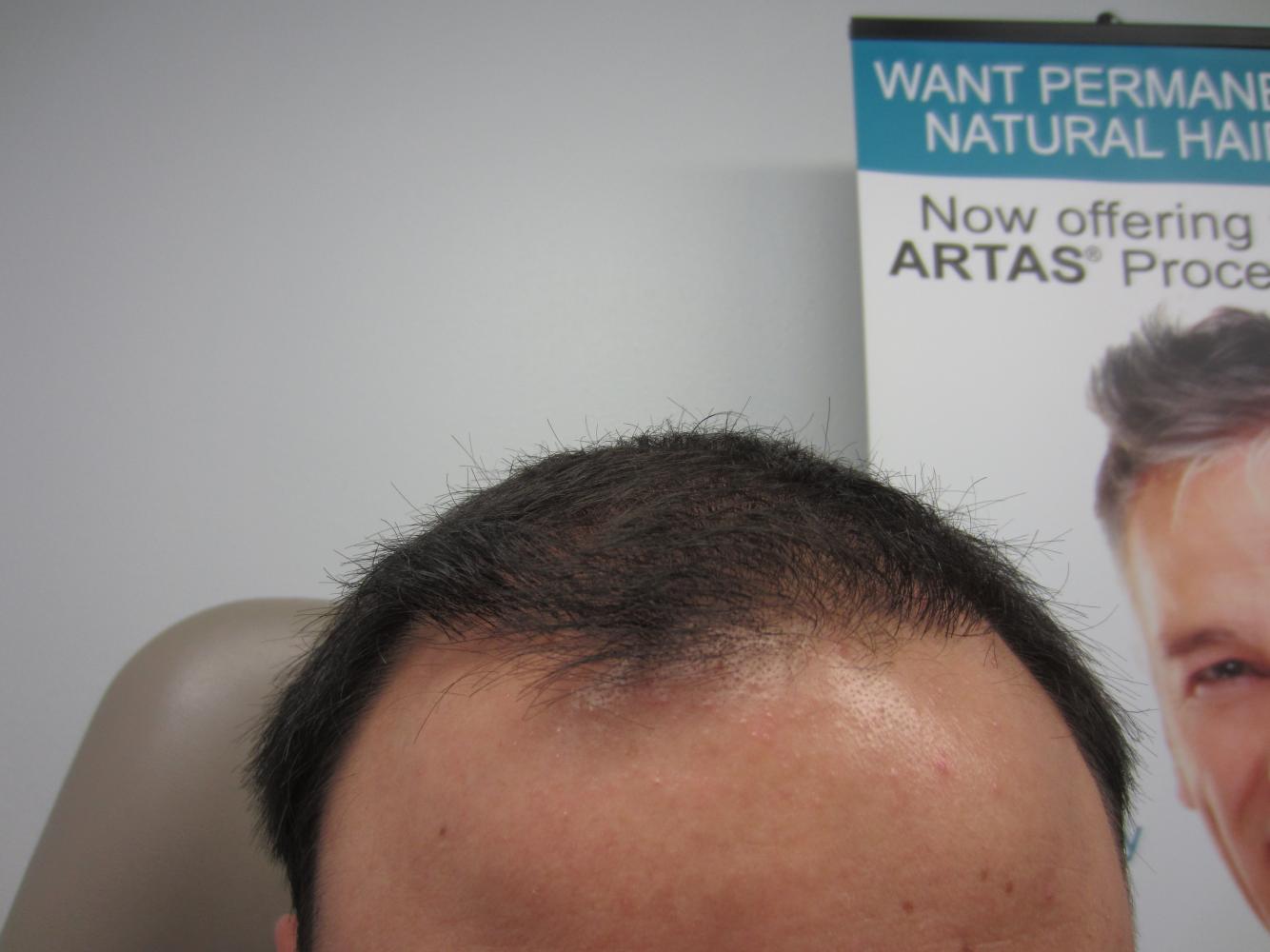 1 Year after hair restoration by FUE grafts