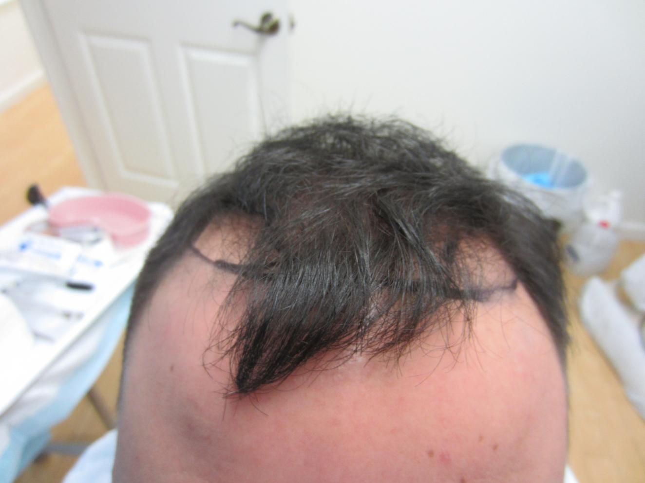 Receding Hair Line Before Hair Transplant.