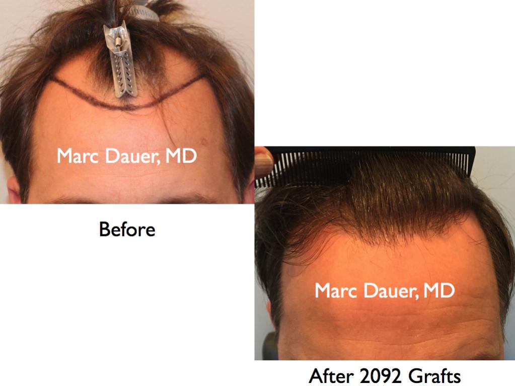 Click image for larger version

Name:	Hair Transplant Slides2.412.jpg

Size:	64.2 KB
ID:	37038