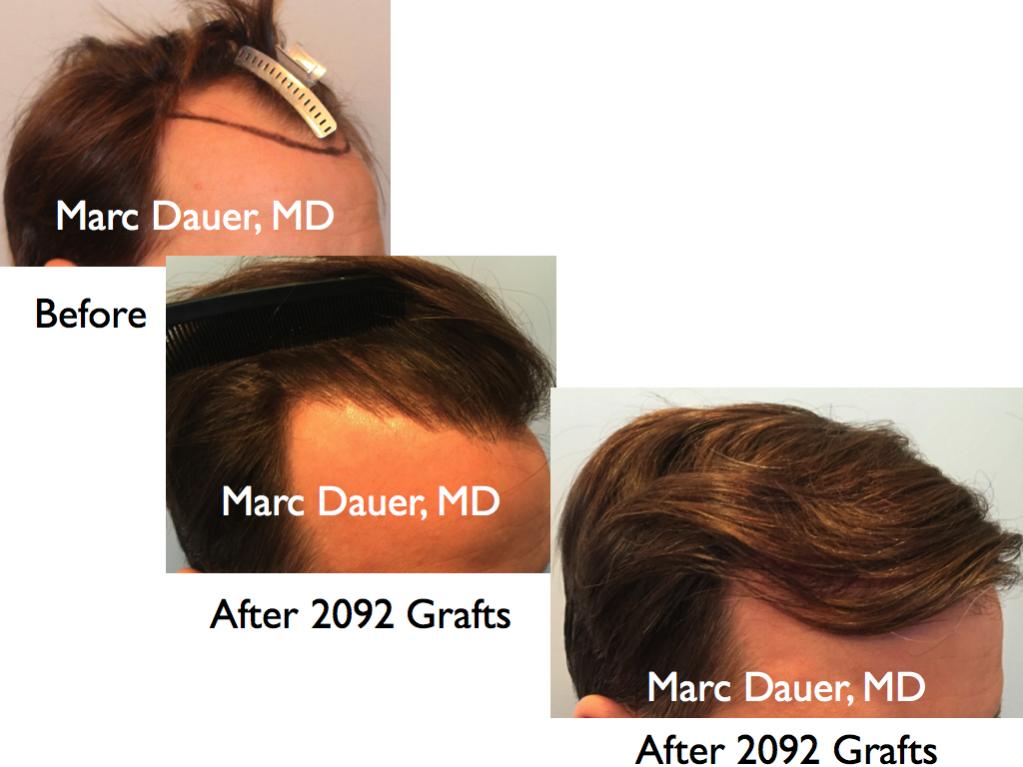 Click image for larger version

Name:	Hair Transplant Slides2.414.jpg

Size:	66.6 KB
ID:	37040