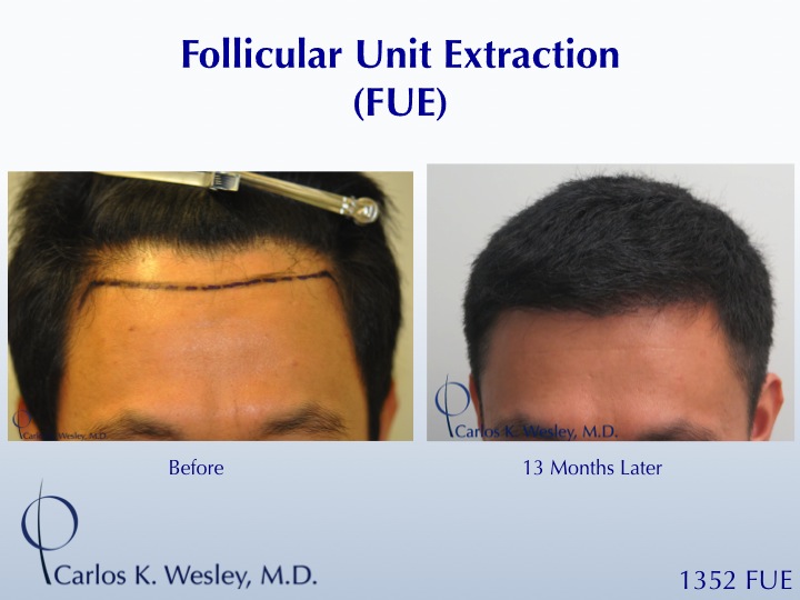 1352 FUE grafts to frontal region.