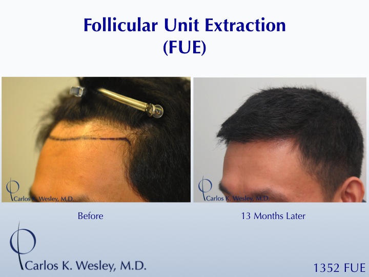 1352 FUE grafts to frontal region