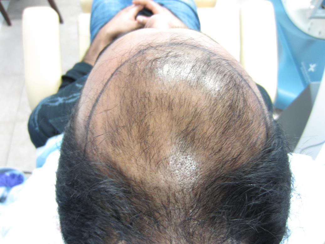 Dr. Rashid Houston FUE 2500 grafts