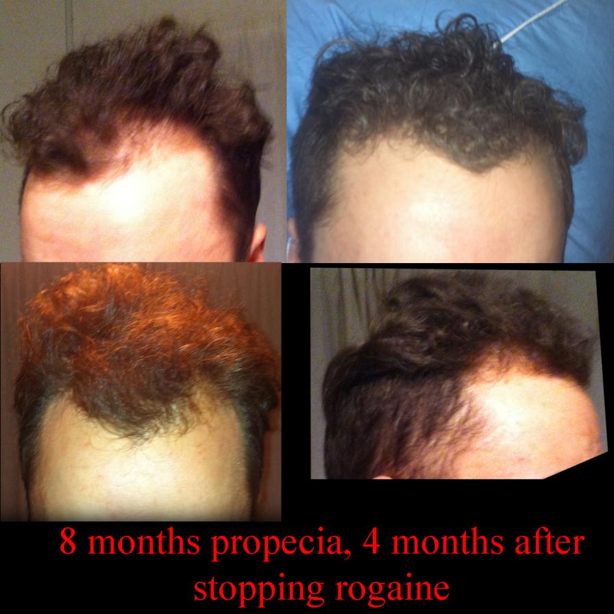 When does finasteride shedding stop?