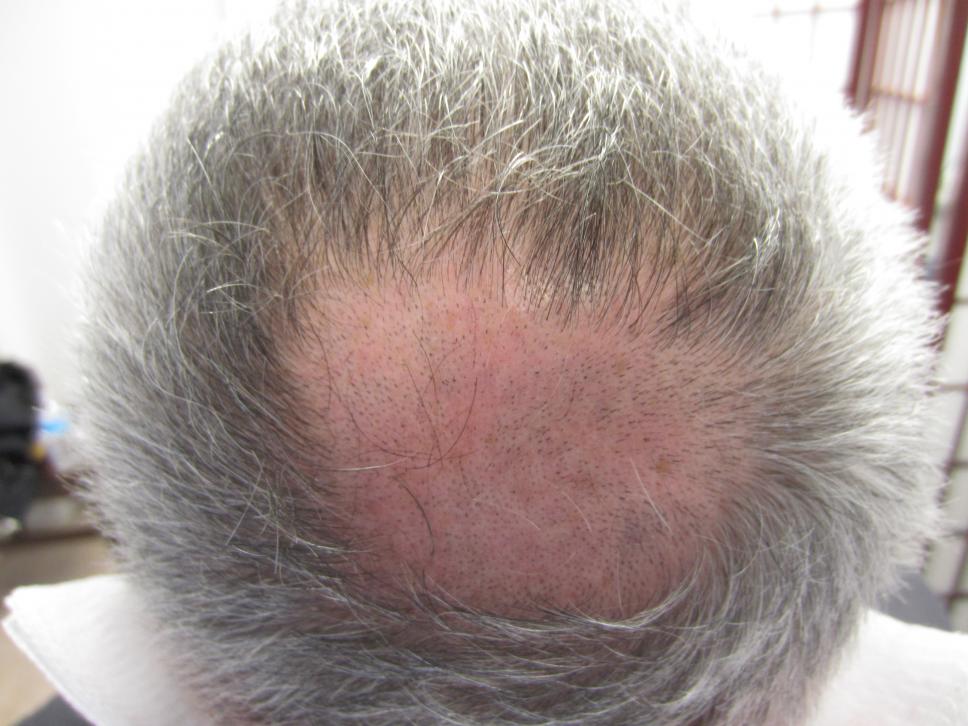 Crown - Houston FUE - Dr. Rashid