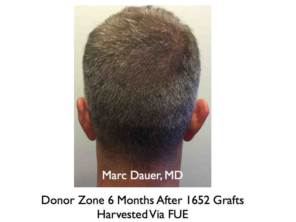 Click image for larger version

Name:	Hair Transplant Slides.543.jpg

Size:	35.9 KB
ID:	38563
