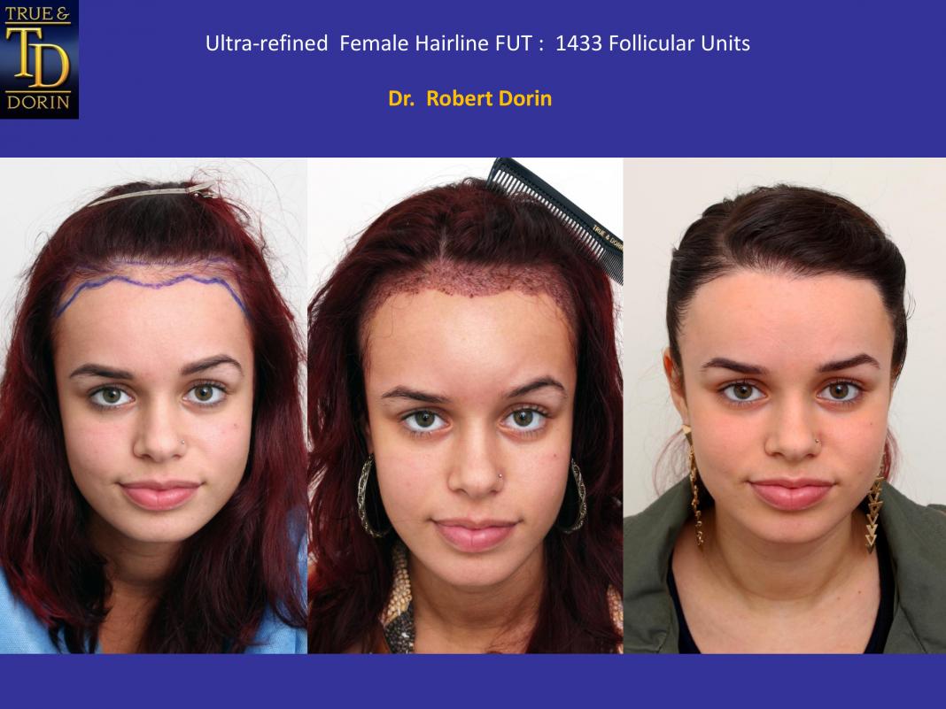 Female Ultra-refined Hair Transplant